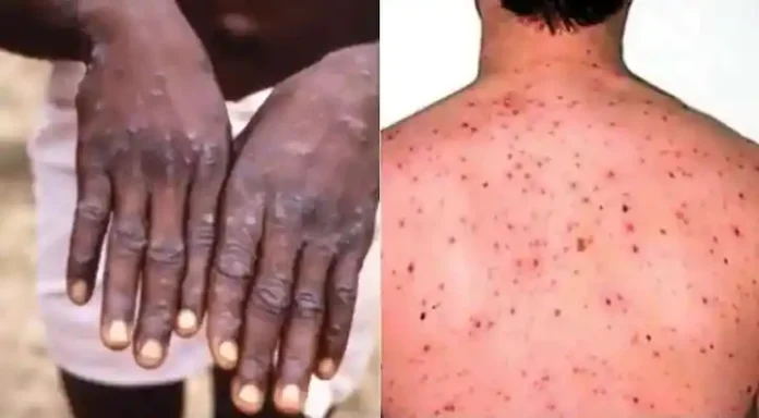 Monkeypox Virus: After Europe-UK, monkeypox knocked in America, know the symptoms of this virus & 10 facts