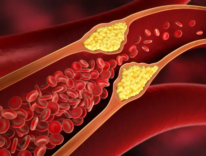 Cholesterol Symptoms: Increase in cholesterol level causes pain in these body parts, know the Symptoms